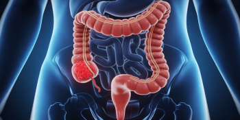 50 anos, famosa e cercada de cuidados: ainda assim, Preta Gil morreu de câncer colorretal